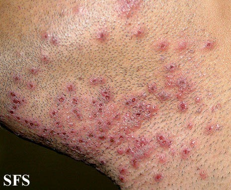A series of close-up images showcasing various symptoms of rare skin conditions, such as unusual rashes, lesions, and discolorations. The images should be clear and detailed, with accurate depictions of each symptom. The lighting should be neutral and informative, highlighting the key characteristics of each condition. The color palette should be medically accurate, using natural skin tones and subtle variations. Photorealistic.