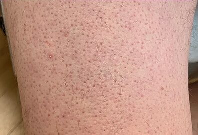 A series of close-up images showcasing various symptoms of rare skin conditions, such as unusual rashes, lesions, and discolorations. The images should be clear and detailed, with accurate depictions of each symptom. The lighting should be neutral and informative, highlighting the key characteristics of each condition. The color palette should be medically accurate, using natural skin tones and subtle variations. Photorealistic.