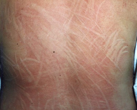 A series of close-up images showcasing various symptoms of rare skin conditions, such as unusual rashes, lesions, and discolorations. The images should be clear and detailed, with accurate depictions of each symptom. The lighting should be neutral and informative, highlighting the key characteristics of each condition. The color palette should be medically accurate, using natural skin tones and subtle variations. Photorealistic.