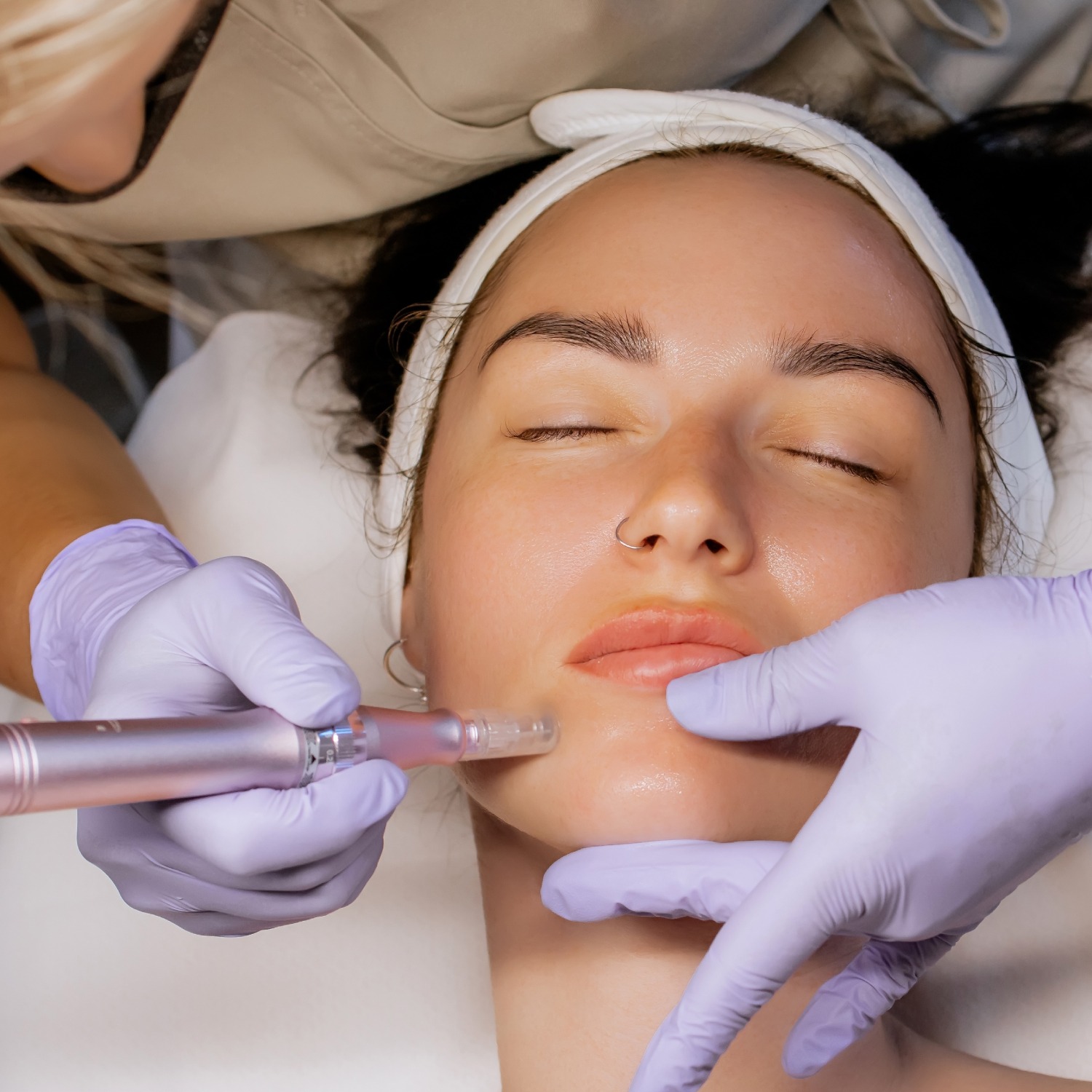 Advanced laser technology being used to rejuvenate skin, with a focus on the precision and effectiveness of the treatment.