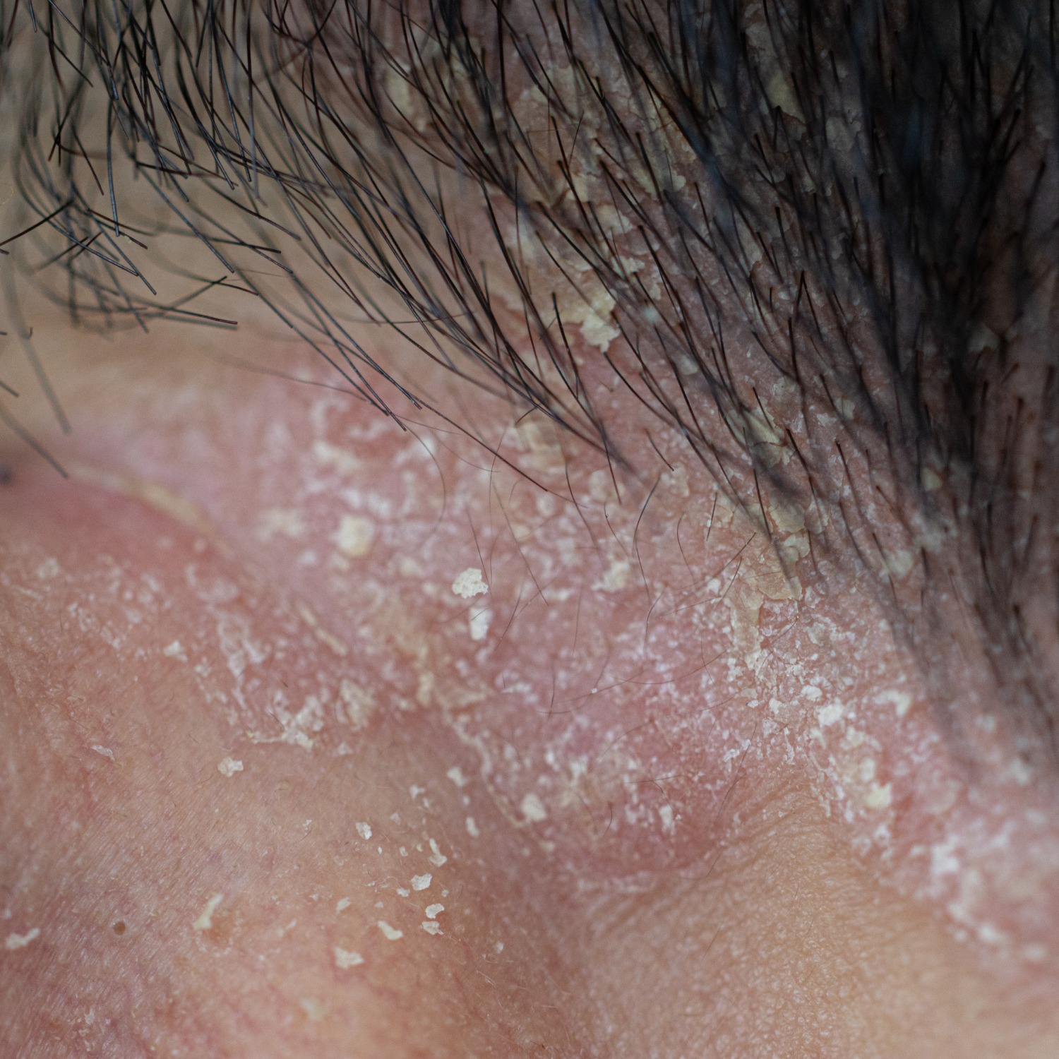 A dermatologist carefully administering a cosmetic injection in a clean, professional environment. Emphasis on precision and safety.